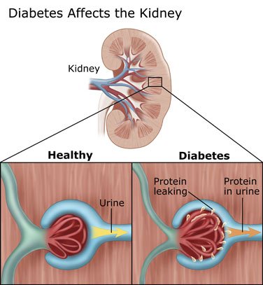 Diabetic Kidney Disease